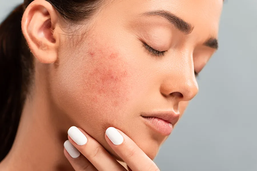 Acne-Clinic Side profile of a woman touching her irritated cheek with visible acne, representing the personalized acne solutions available by Dr. Noelani Rodriguez in San Diego.