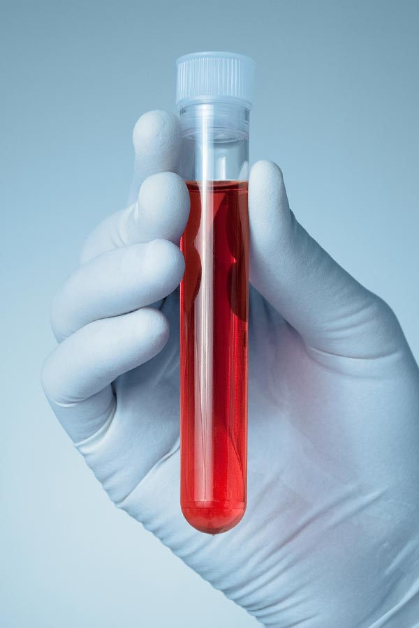 Autoimmune-Treatment Close up of a gloved hand holding a vial of red liquid, representing Dr. Noelani Rodriguez's comprehensive autoimmune disorder treatment in San Diego.