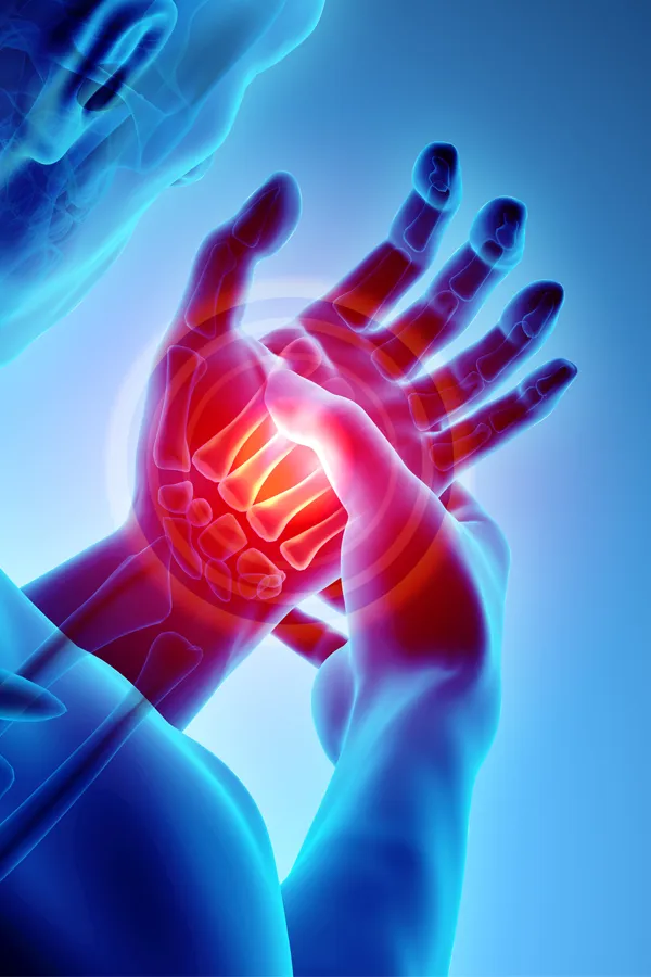 Carpal-Tunnel-Syndrome-Treatment 3D illustration of a hand with carpal tunnel syndrome. Get treatment for carpal tunnel syndrome from Dr. Noelani Rodriguez in San Diego.