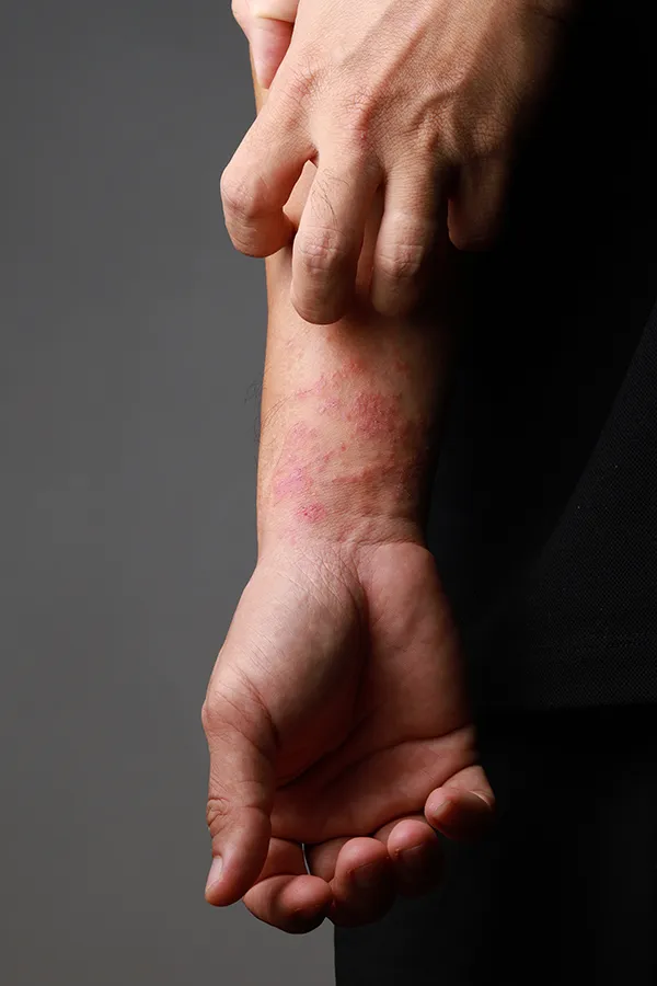 Eczema-Treatment One hand scratches an area irritated by eczema on the other wrist. Get treatment for eczema from Dr. Noelani Rodriguez in San Diego.