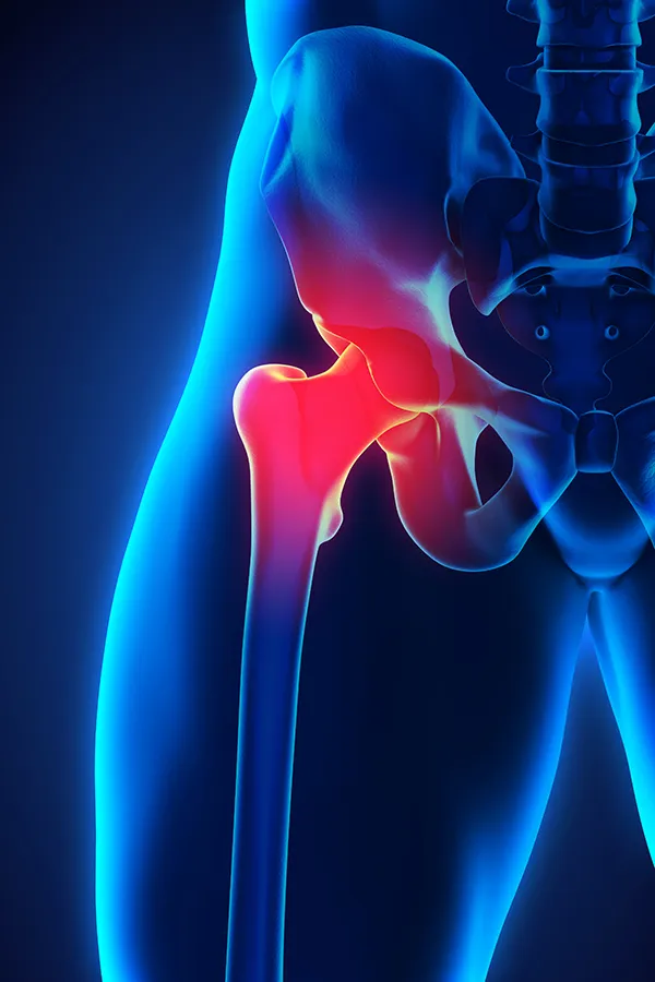 Labrum-Tears-Treatment 3D illustration of the human hip joint. Get treatment for larum tears from Dr. Noelani Rodriguez in San Diego.