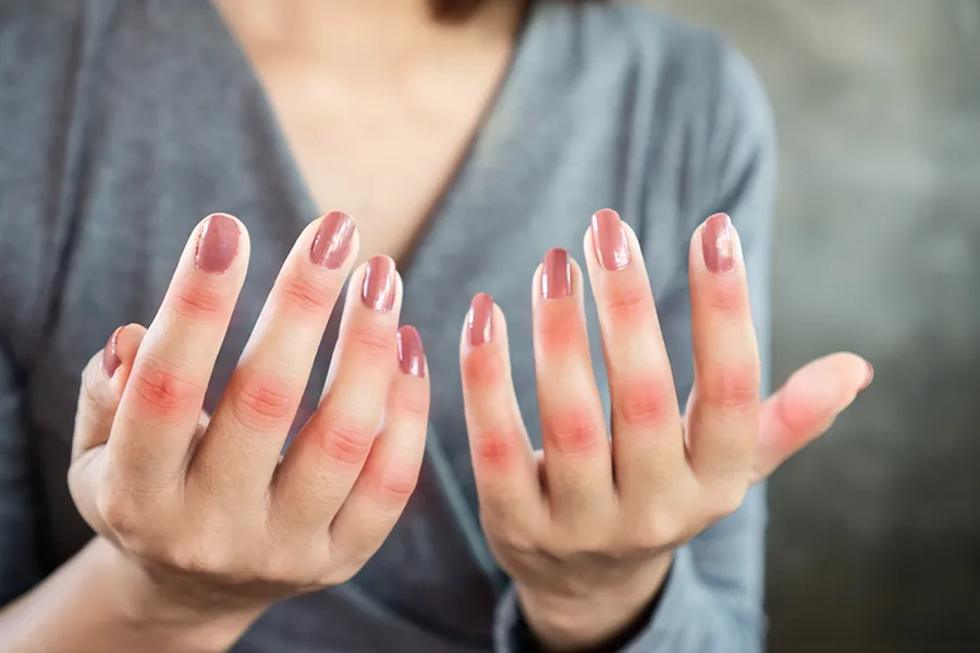 Lupus-Clinic Close-up of the hands of a woman in a gray shirt, with swollen, red knuckles. Get treatment for Lupus from Dr. Noelani Rodriguez in San Diego.