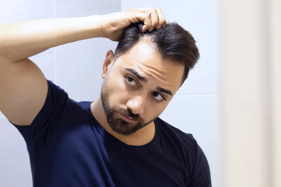 PRP-for-Hair-Loss-Doctor A man in a navy t-shirt looks in the mirror worrying about and touching his receding hairline, considering PRP for hair loss and restoration treatment from Dr. Noelani Rodriguez in San Diego.