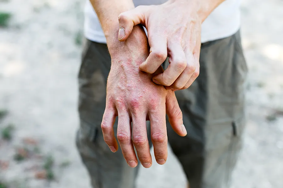 Psoriasis-Clinic Close-up of a man scratching his hands while experiencing Psoriasis. Get care for Psoriasis from Dr. Noelani Rodriguez in San Diego.