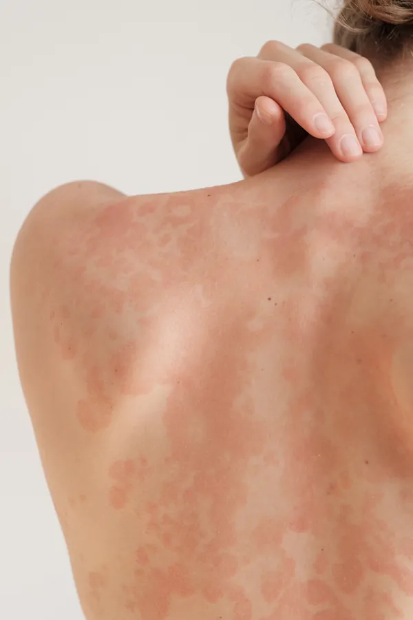 Psoriasis-Treatment The back and shoulder of a woman experiencing Psoriasis. Get treatment for Psoriasis from Dr. Noelani Rodriguez in San Diego.