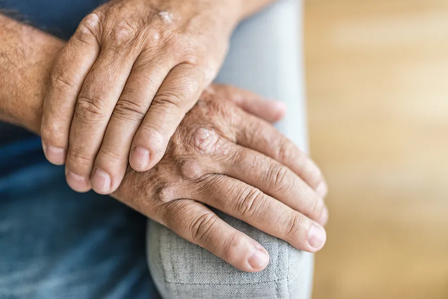 Psoriatic-Arthritis-Clinic Close-up of a mature mans hands showing signs of psoriatic arthritis. Get treatment for psoriatic arthritis from Dr. Noelani Rodriguez in San Diego.