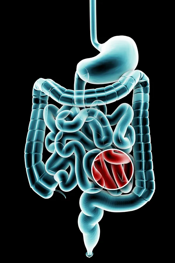 Ulcerative-Colitis-Treatment 3D illustration of the digestive system in blue tones, with an area of discomfort in red tones. Get treatment for Ulcerative Colitis from Dr. Noelani Rodriguez in San Diego.